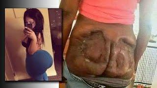 Did This Woman's Brazilian Butt Lift Implants Explode??